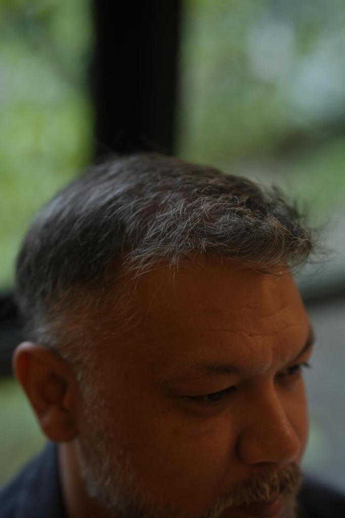 Hairline restoration — after