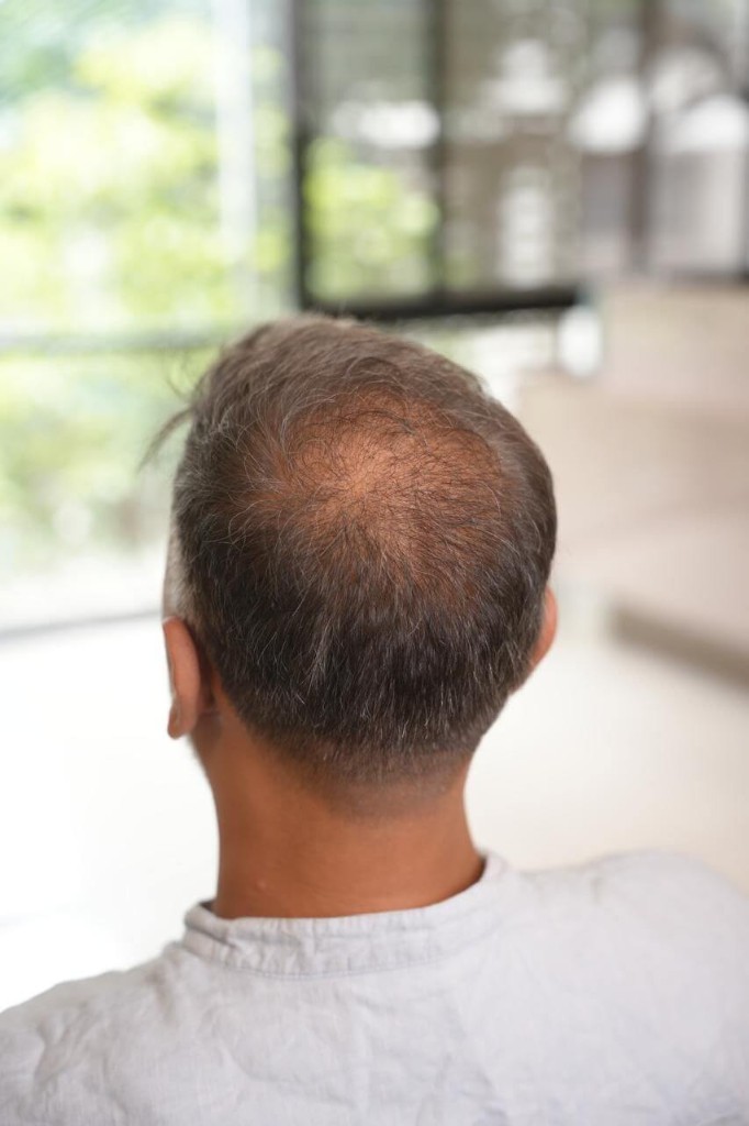 Hairline restoration — before